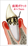 中度歯周病のイメージ